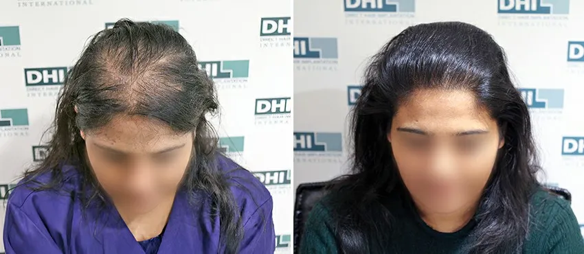 Female before and after hair transplant results