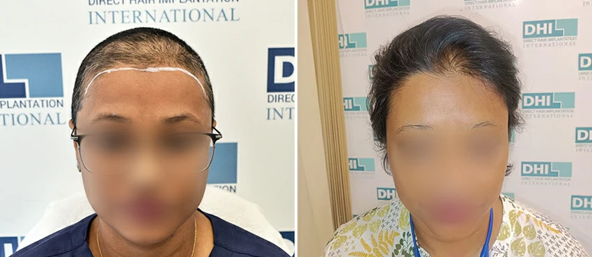 Female before and after hair transplant results