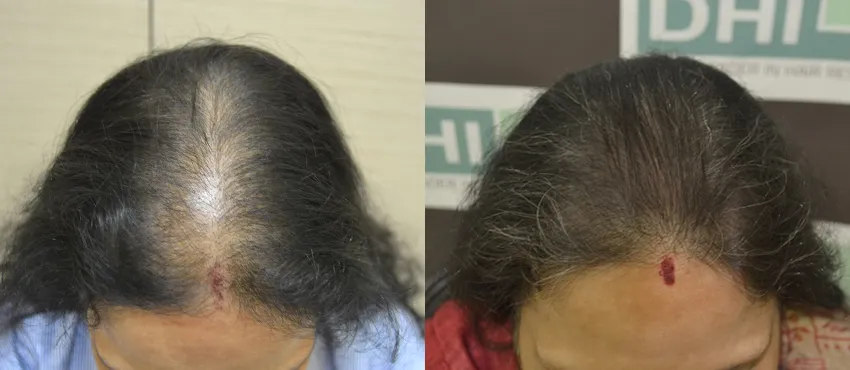 Female before and after hair transplant results