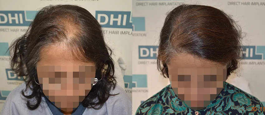 Female before and after hair transplant results