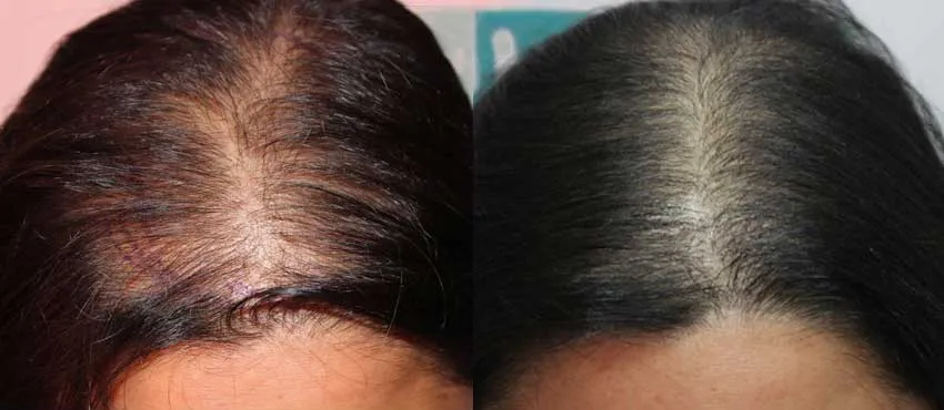 Female before and after hair transplant results