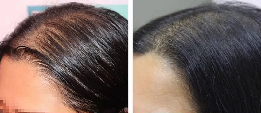 Female before and after hair transplant results
                                         
