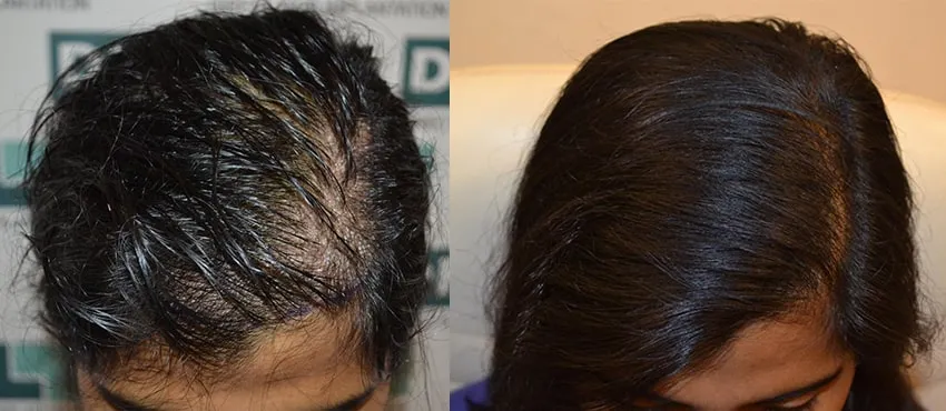 Female before and after hair transplant results