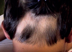 Alopecia Areata