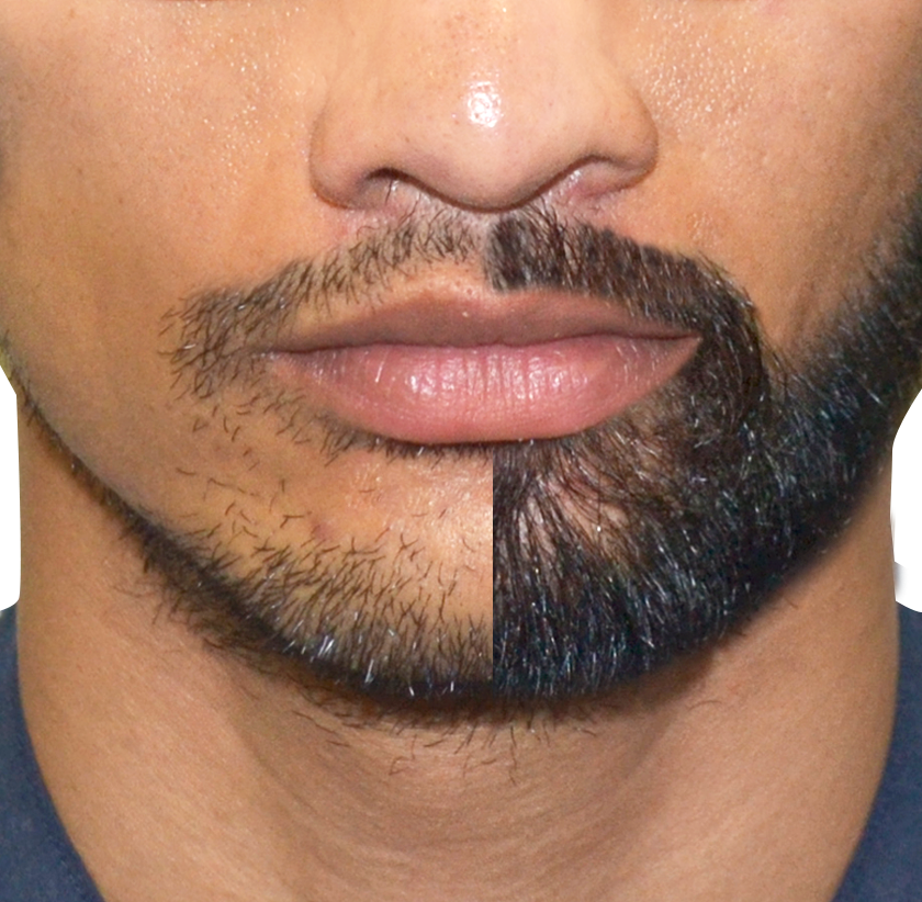 beard hair transplant