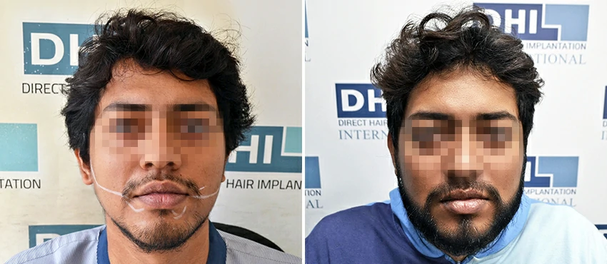  beard hair transplant results