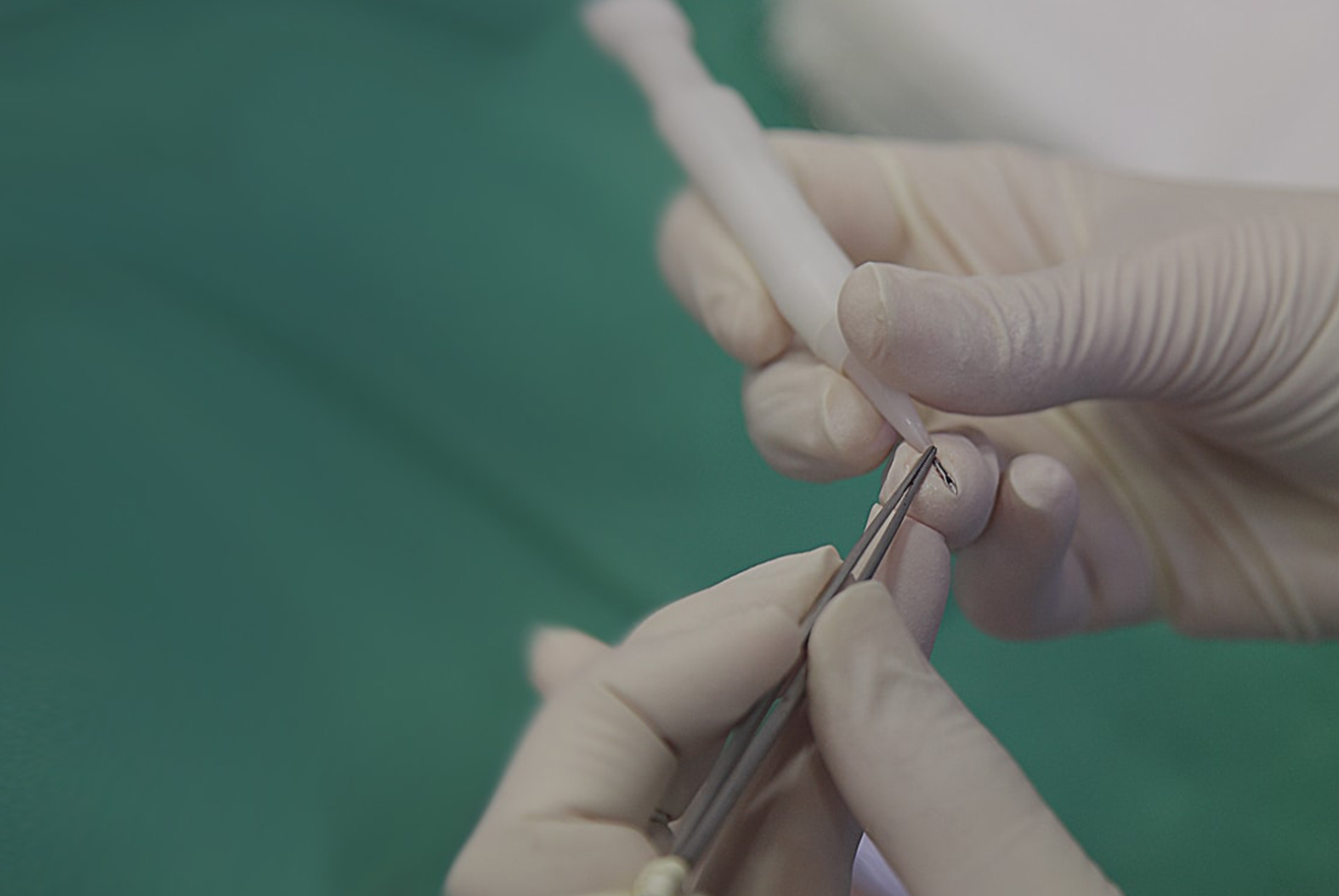 Hair Follicles Implantation