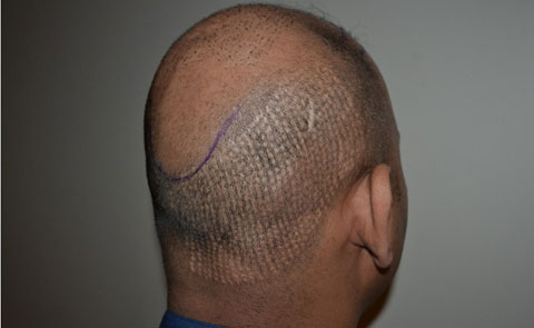 Donor area after FUE surgery