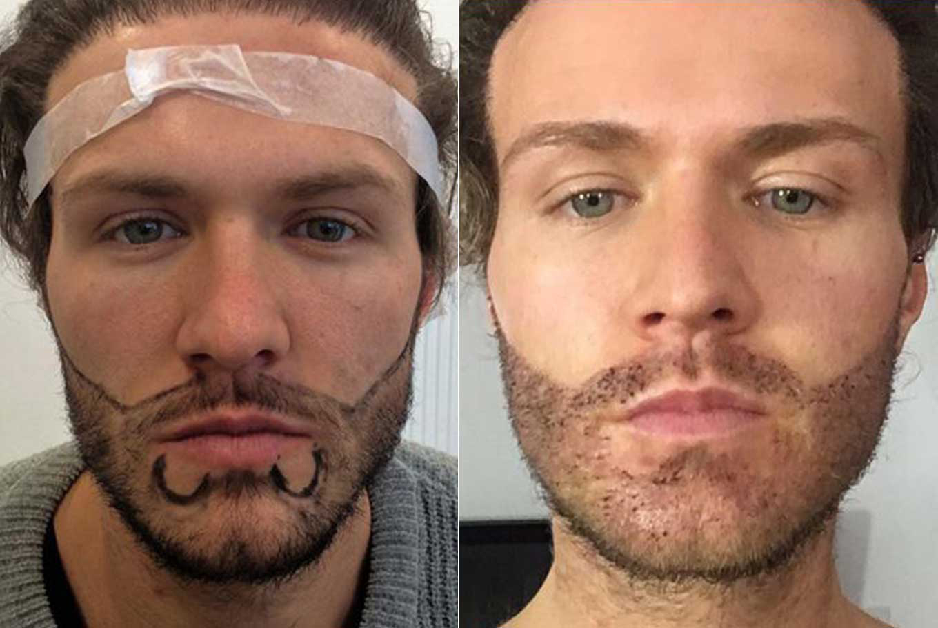 Beard Hairline Designing
                                