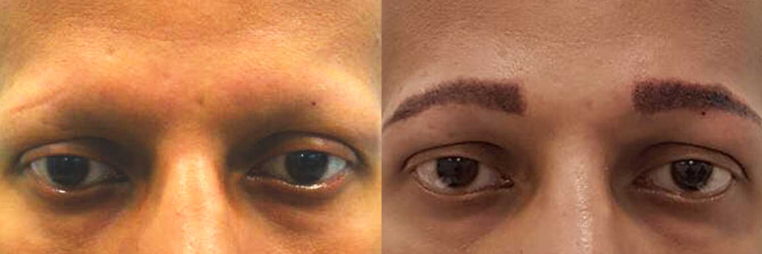 DHI Micropigmentation