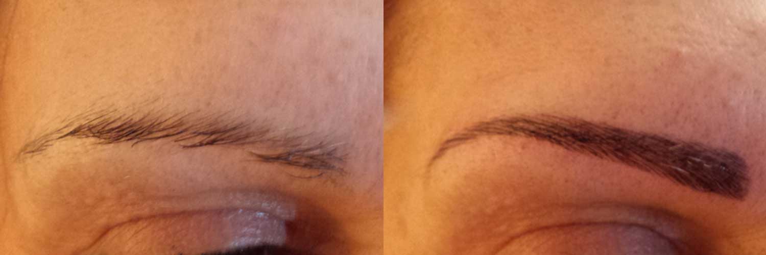 Eyebrow Restoration Example