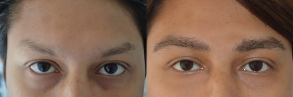 Eyebrow Transplant Patient Result