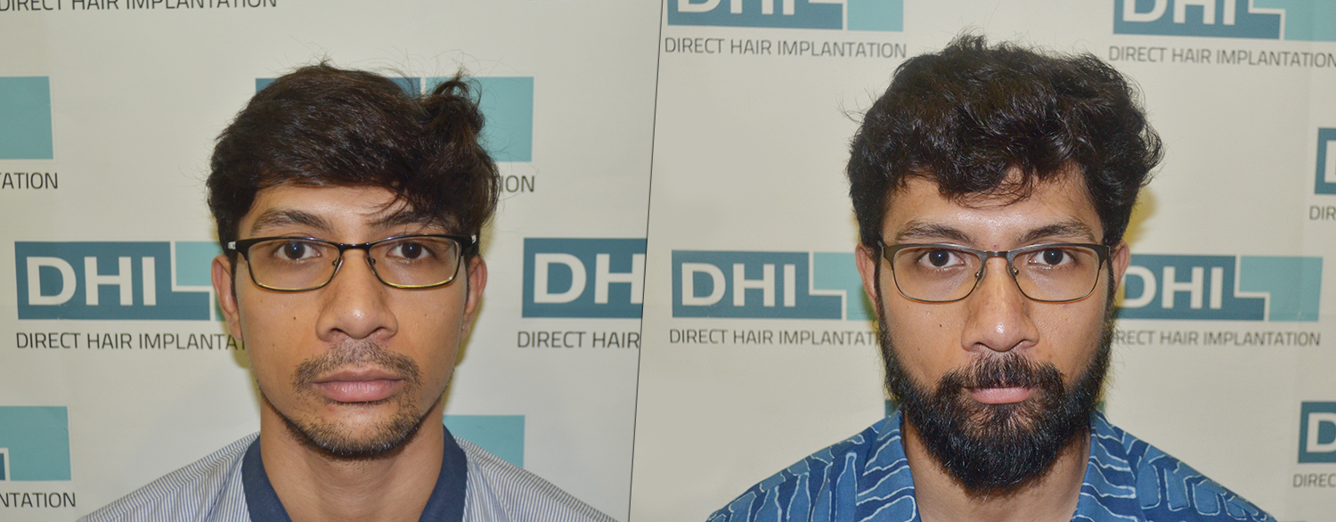 beard hair transplant before & after results