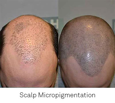 Scalp Micropigmentation