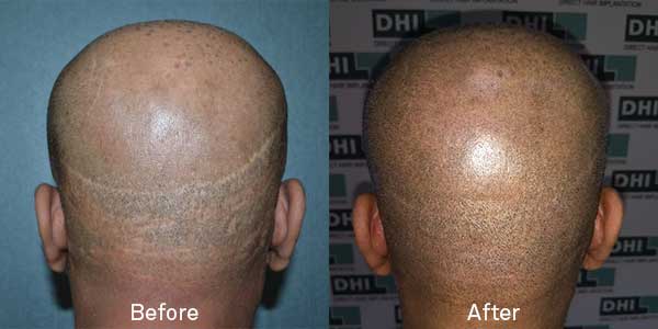 FUT scar repair using DHI