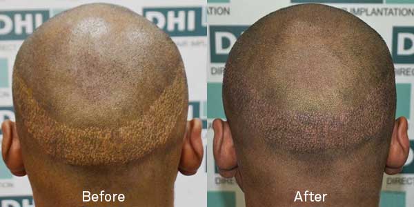 Scalp micropigmentation for scar repair