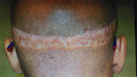 Hair transplant scar