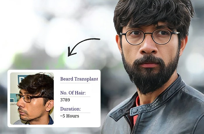 beard Transplant