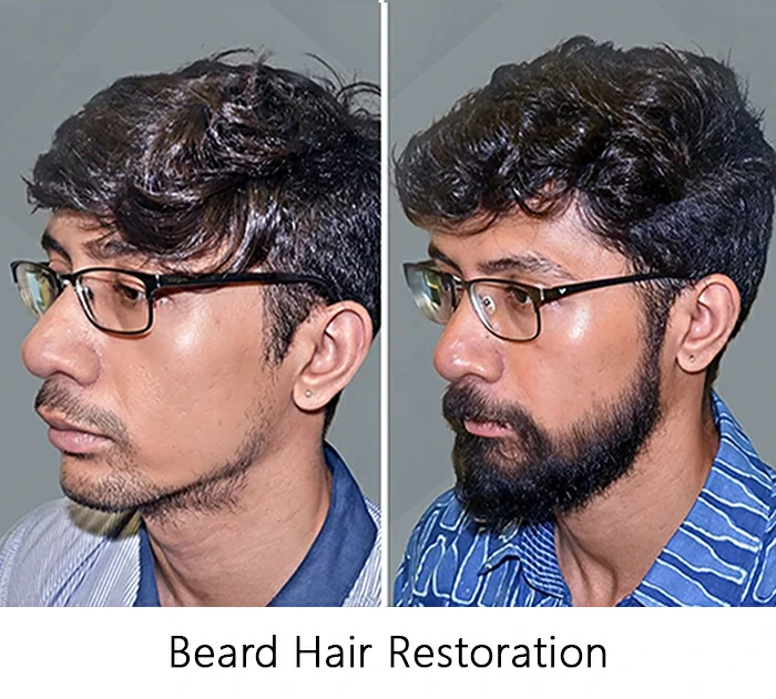 Beard-Hair-Restoration