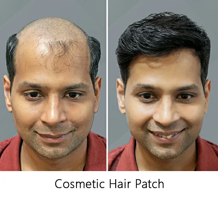 Cosmetic-Hair-Patch