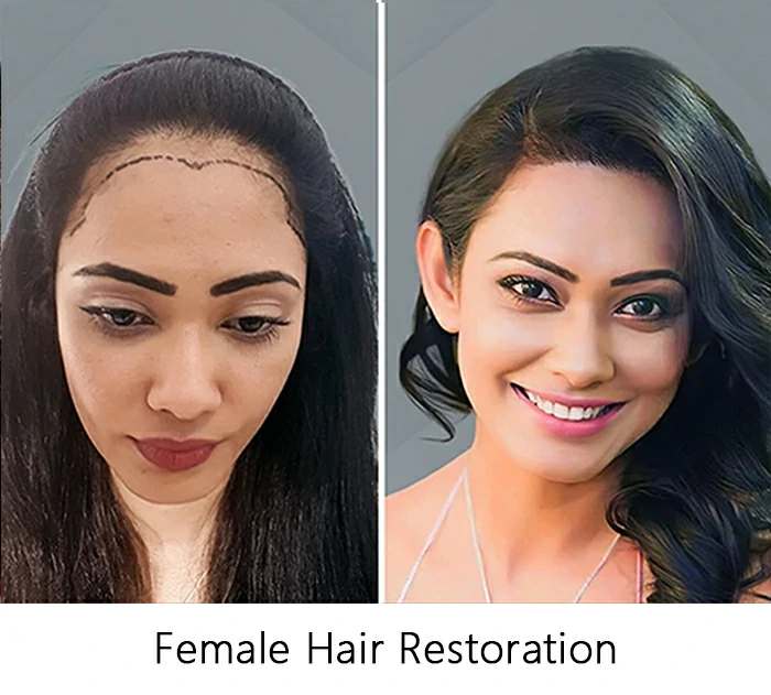 Female-Hair-Restoration