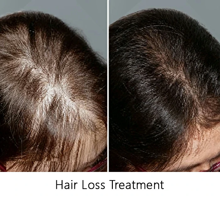 Hair-Loss-Treatment