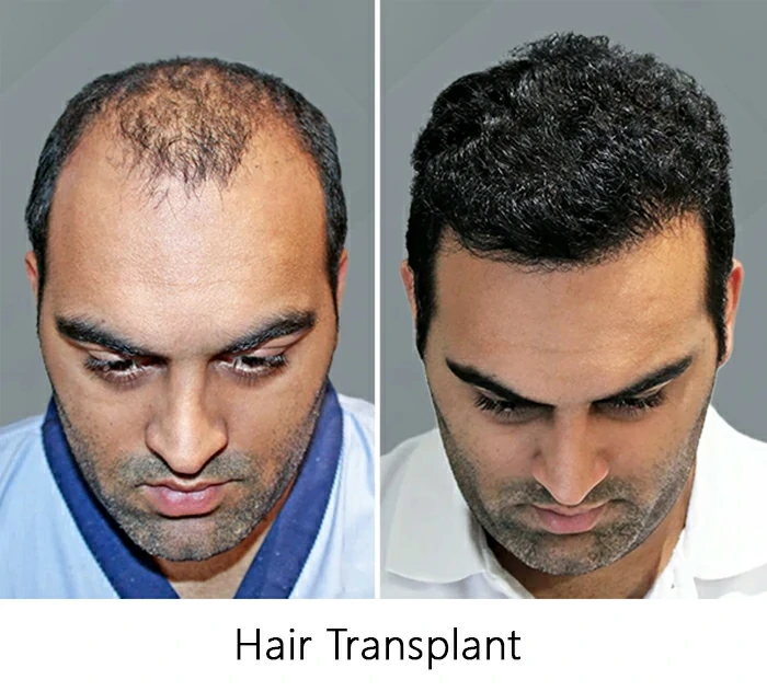 Hair-Transplant
