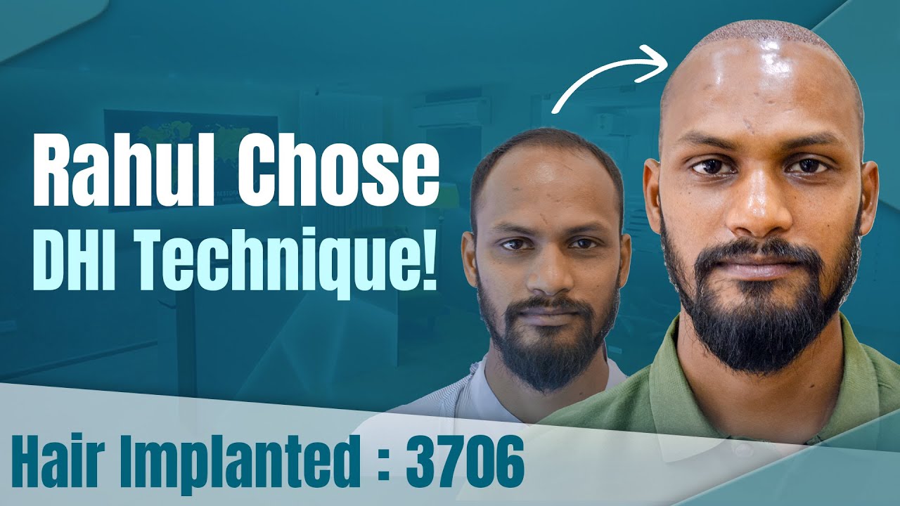 hair transplant video 1