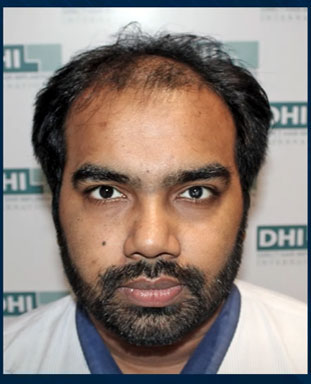 hair transplant video 1