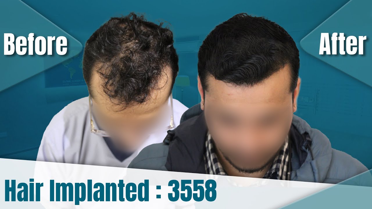 hair transplant video 1