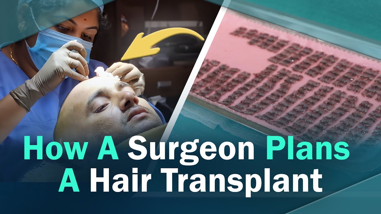 hair transplant video 1