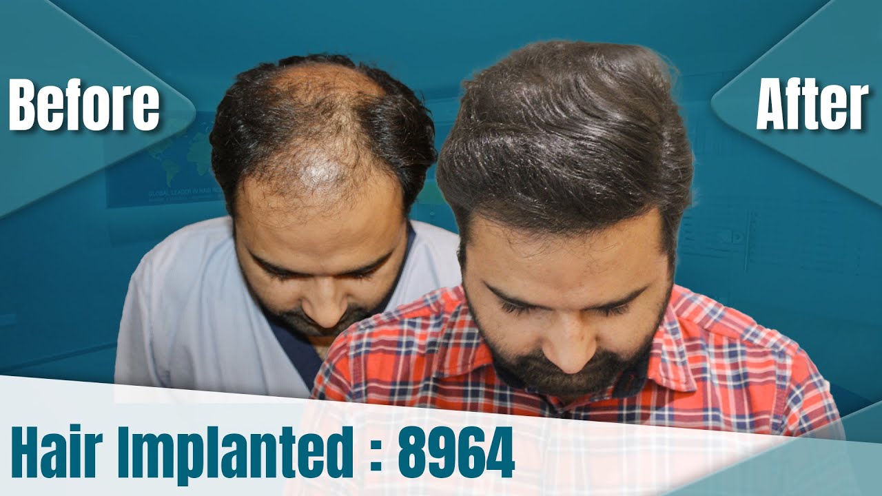 hair transplant video 1