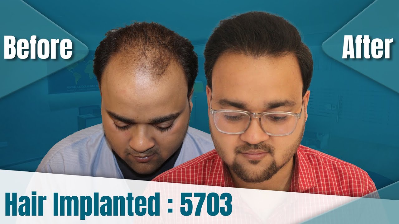 hair transplant video 1
