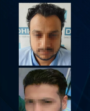 hair transplant video 1