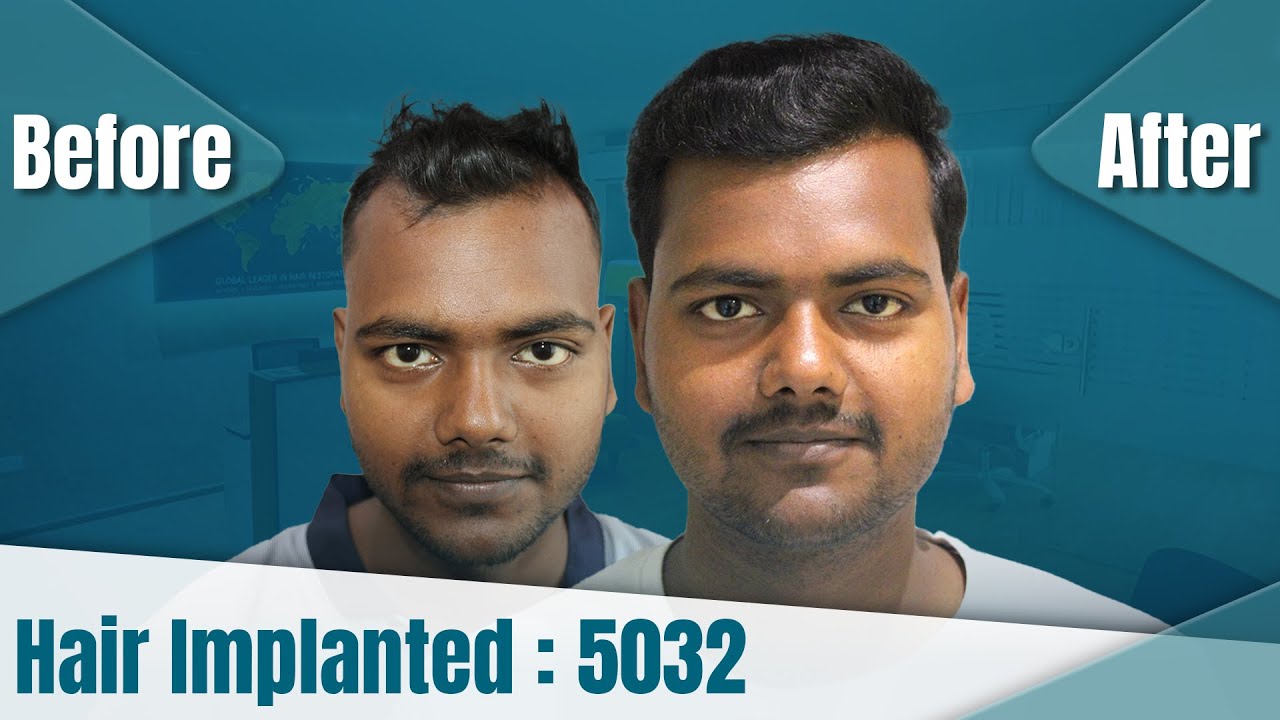hair transplant video 1