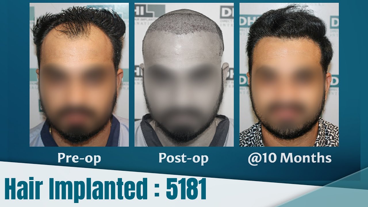 hair transplant video 1
