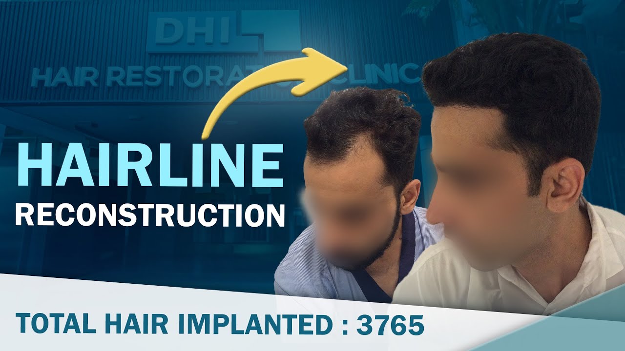 hair transplant video 1