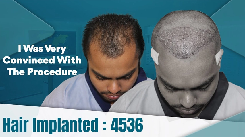hair transplant video 1