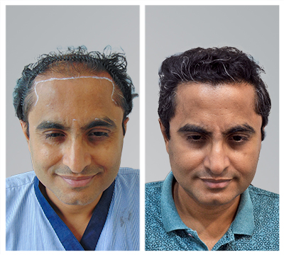 Bangalore hair transplant clinic
