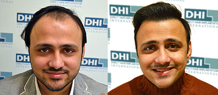 hair transplant mumbai