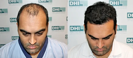 hair transplant ahmedabad