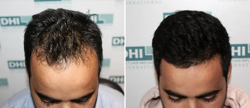 best hair transplant clinic in chandigrah
