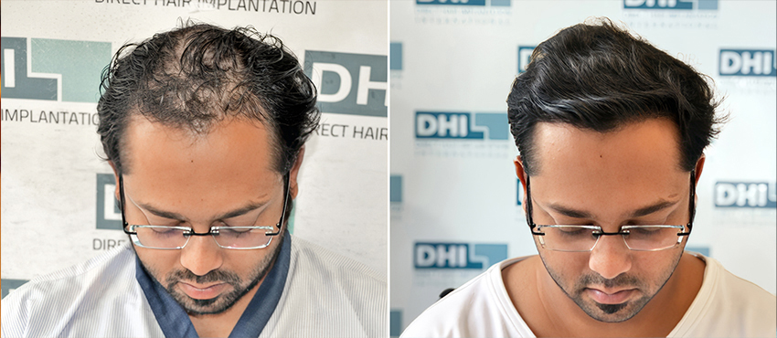 Hair Transplant Before & After Results