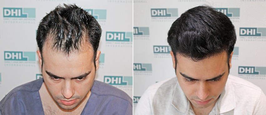 Hair transplant results Gurgaon