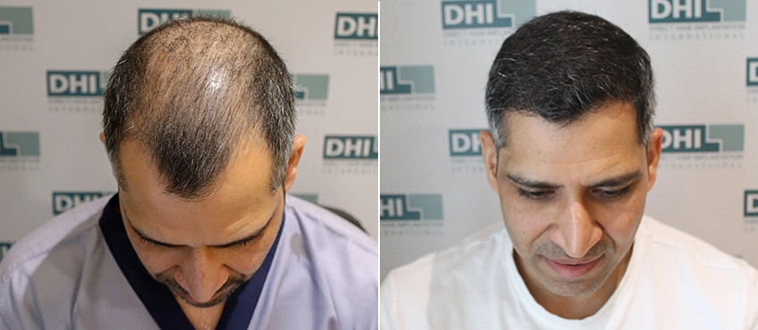 delhi hair transplant before and after
