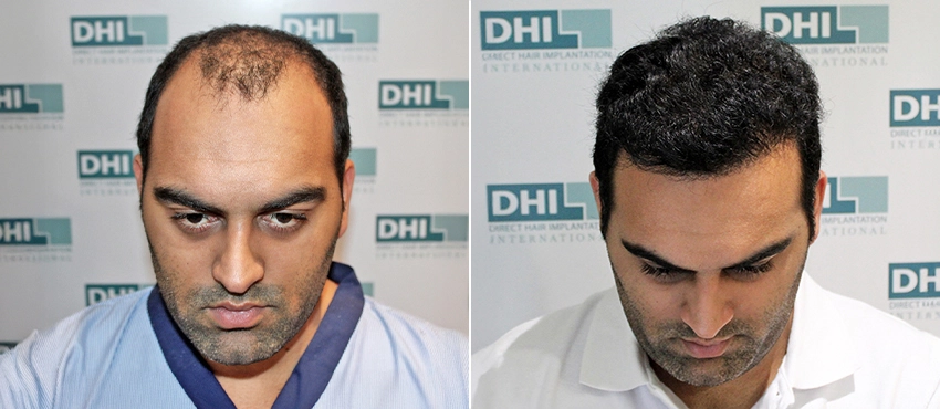 delhi hair transplannt results
