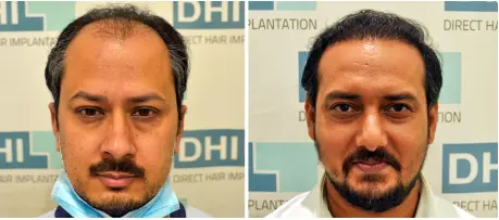 best hair transplant clinic in delhi