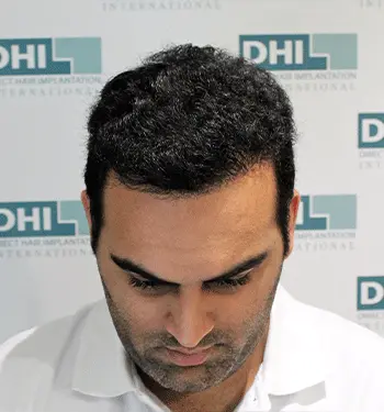 Hair fixing and PRP therapy in Calicut