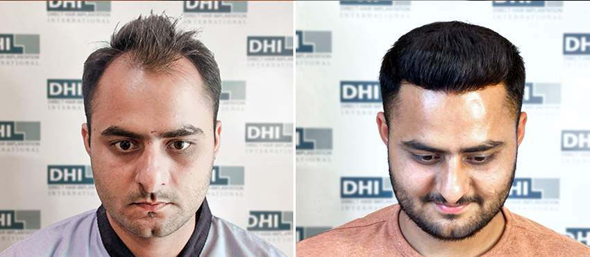 before and after hair transplant
