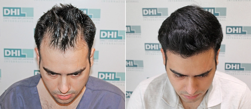 Hair transplant results hyderabad